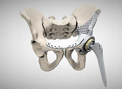 多地3D打印技术辅助医疗，满足患者个体化的诊疗需求
