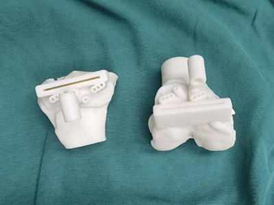 D打印个性化手术导板成功助力复杂人工膝关节置换手术，化繁为简！